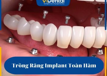 Trồng răng Implant toàn hàm là một phương pháp phục hình thẩm mỹ răng đã mất
