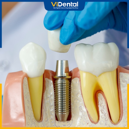 Implant ETK có thể áp dụng điều trị với mọi tình trạng răng