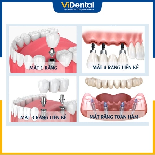 Có thể sử dụng trụ Implant Neodent với nhiều tình trạng răng khác nhau
