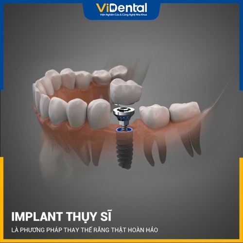 Trụ Implant Thụy Sĩ có nhiều tính năng nổi bật hỗ trợ quá trình cấy ghép Implant
